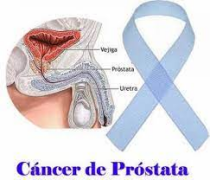 Cáncer de próstata es el segundo más diagnosticado en el mundo