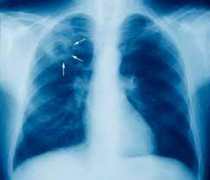 En República Dominicana se detectan 4,000 casos de tuberculosis cada año; el 23 % son VIH positivo